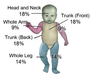 Rule of Nines for infants