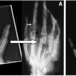 X-ray images showing different types of fractures and fracture reductions