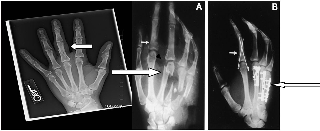 Figure 2: X-Ray Images of Finger Fractures and Fixation Techniques - Depicts closed and open reduction, percutaneous pin fixation, and internal fixation with plates and screws for fracture care coding education.